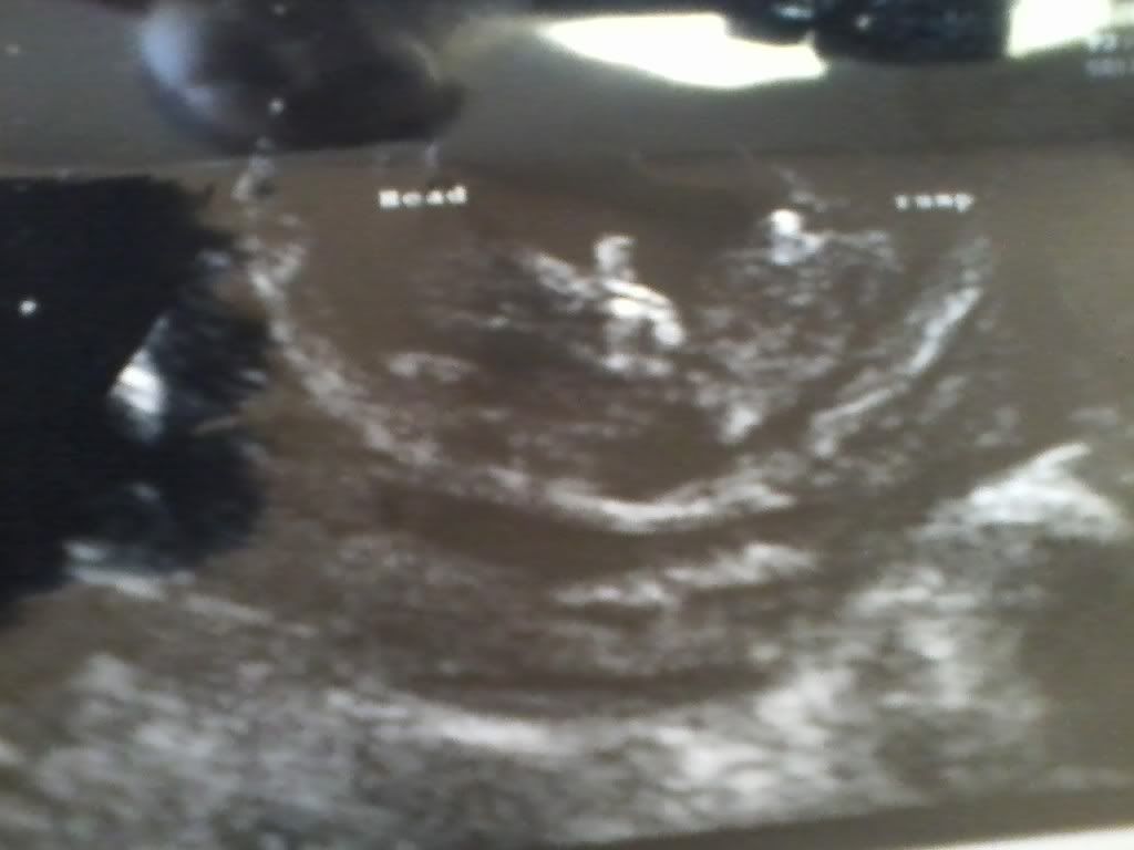 Post Your Confirmed BOY Nub Theory and Potty Shots Here in Ultrasound Gender Prediction Forum