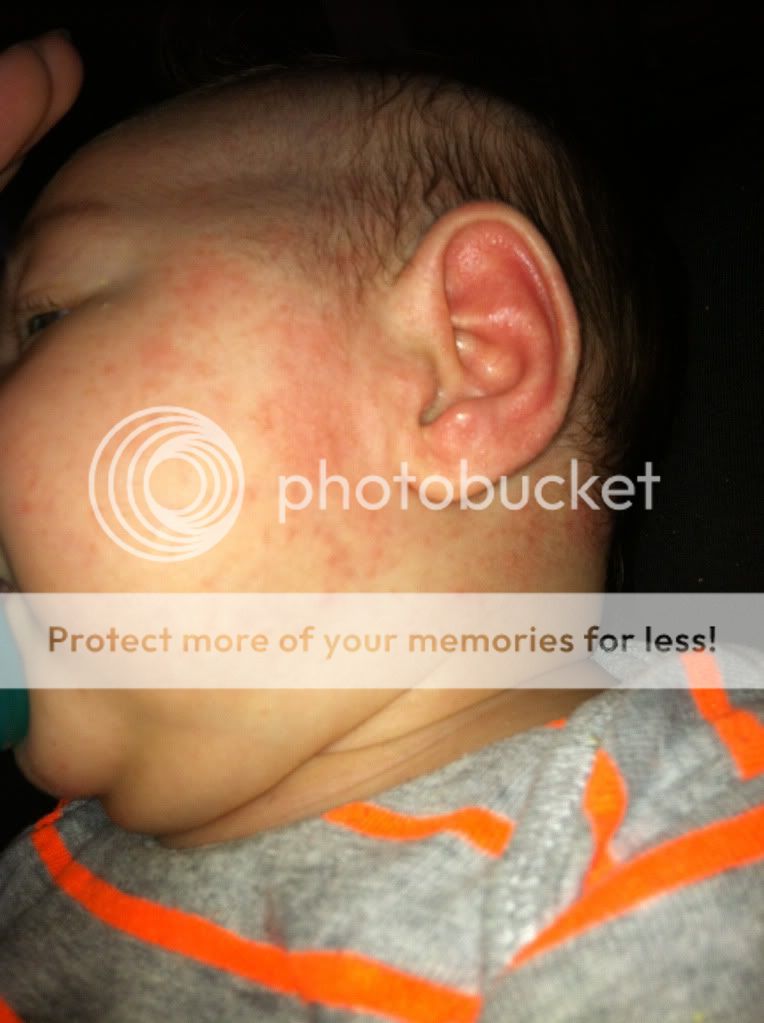 red-bumps-on-face-pic-babycenter